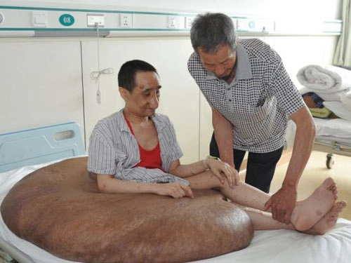 Người đàn ông mang khối u lớn nhất thế giới 110 kg