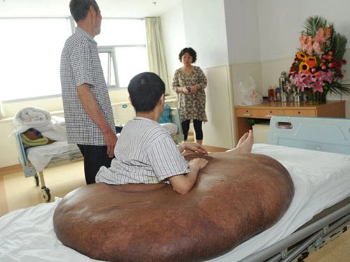 Người đàn ông mang khối u lớn nhất thế giới 110 kg