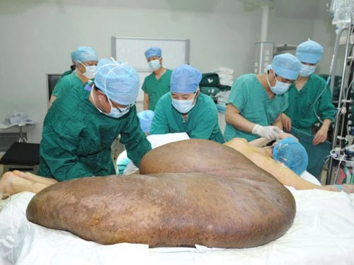 Người đàn ông mang khối u lớn nhất thế giới 110 kg