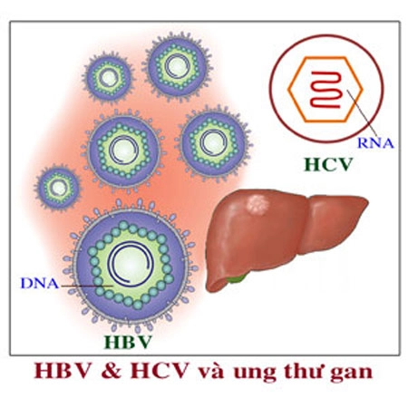 Tránh xa sát thủ vô hình gây ung thư