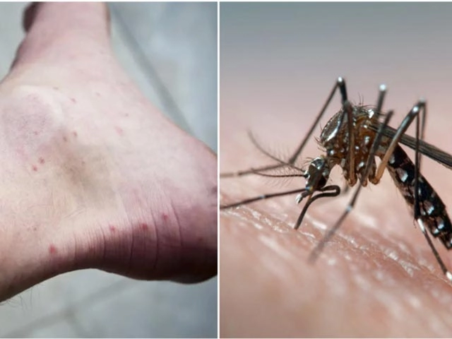 Việt nam ghi nhận trường hợp đầu tiên mắc bệnh do virus zika