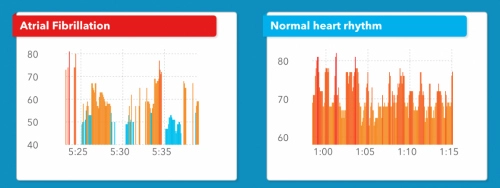Apple watch giúp phát hiện ra nguy cơ suy tim cực chính xác