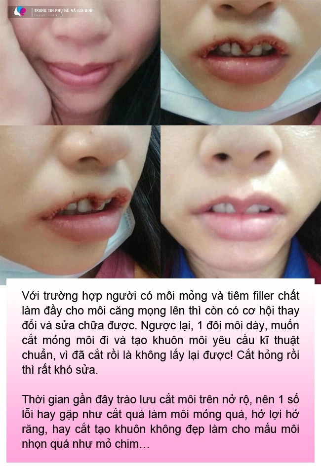 Cắt môi trái tim gái xinh nhận về đôi môi như củ ấu có ca còn như cửa không cánh