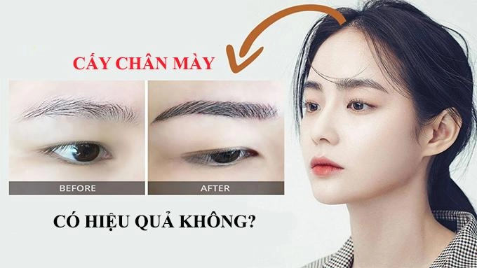 Cấy lông mày - phương pháp làm đẹp không đau phái đẹp yêu thích nhất