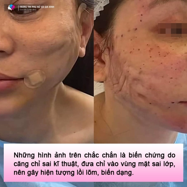 lạnh gáy những pha cấy chỉ căng da của chị em trung niên đẹp chưa thấy ngắm đã xót