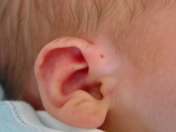 Mẹ cứ ngỡ con có lỗ nhỏ ở vành tai là thông minh nhưng sự thật lại rất nguy hiểm