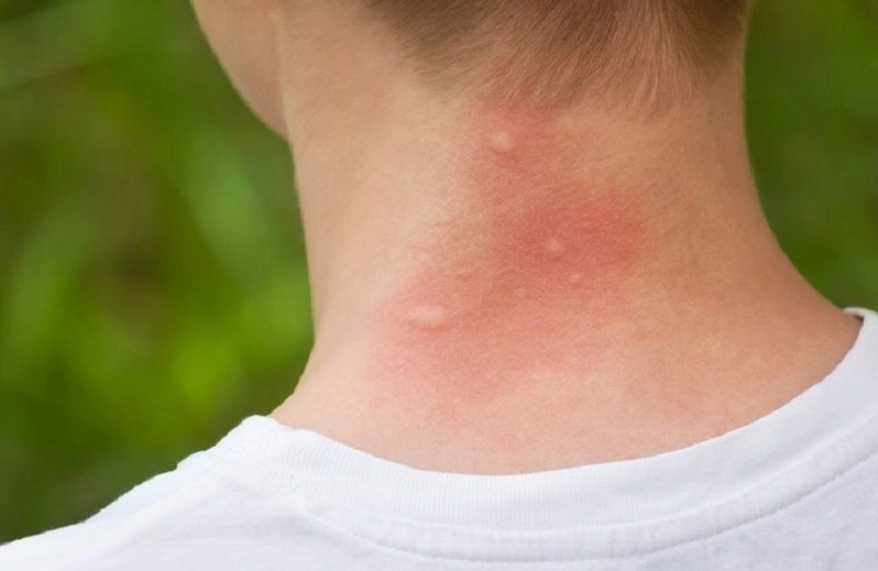 Trẻ bị nổi mẩn đỏ như muỗi đốt khắp người mẹ chớ nên chủ quan