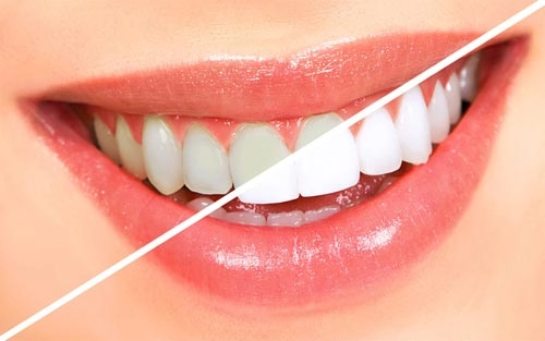 7 nguyên liệu nhà bếp giúp răng trắng bóng không cần kem đánh răng