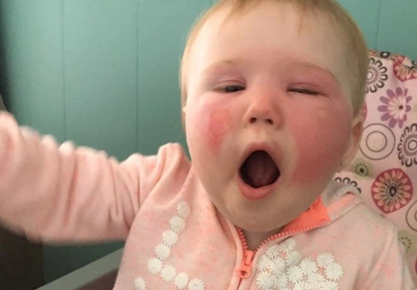 Bôi kem chống nắng đúng theo chỉ định bé 14 tháng bị bỏng biến dạng toàn khuôn mặt