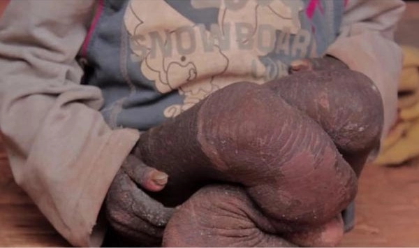 Ngỡ ngàng trước diện mạo mới thay da đổi thịt của cậu bé 11 tuổi mắc căn bệnh hóa đá