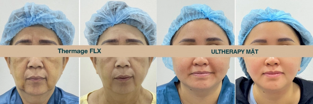 Ruco trở thành nơi có số ca điều trị nâng cơ ultherapy 