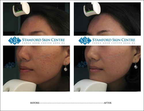 Stamford skin centre tự hào 10 năm với 15000 ca điều trị da thành công