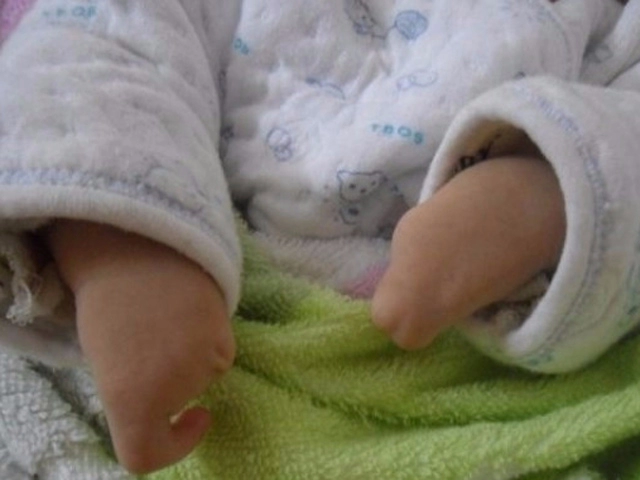 Xót thương bé sơ sinh chào đời với hình dạng bàn tay bàn chân giống như càng cua