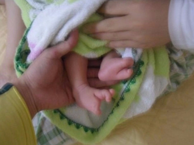 Xót thương bé sơ sinh chào đời với hình dạng bàn tay bàn chân giống như càng cua