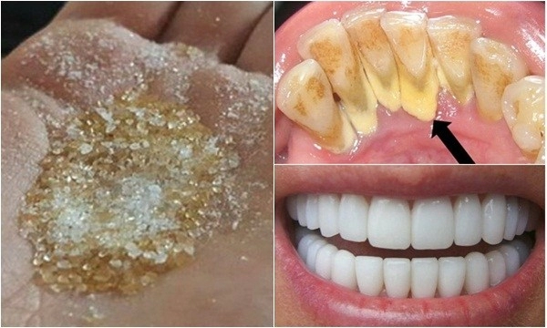 20 cách làm trắng răng nhanh nhất an toàn hiệu quả tại nhà