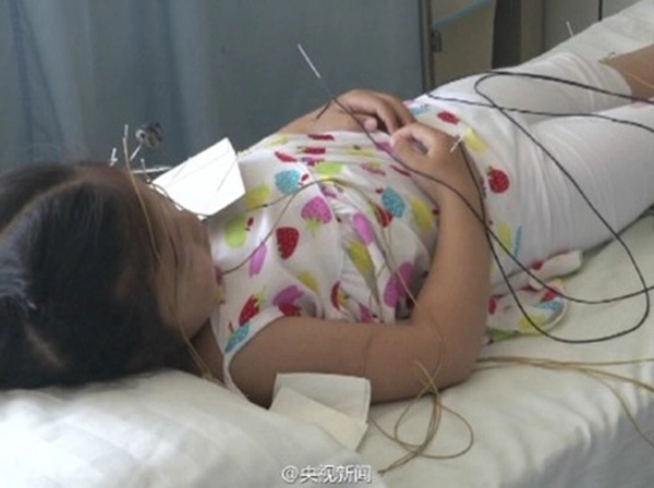 Bé gái 2 tuổi liệt mặt sau giấc ngủ trưa vì nằm phòng điều hòa giữa thời tiết nắng nóng