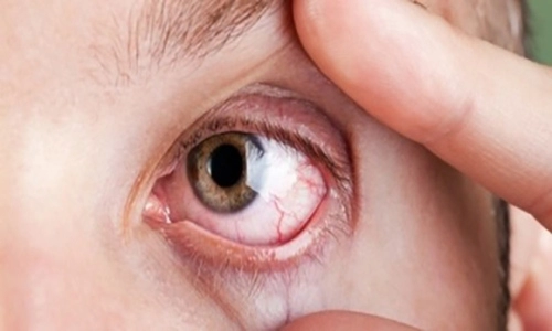 Dấu hiệu cảnh báo bệnh tật nguy hiểm qua đôi mắt cần khám ngay