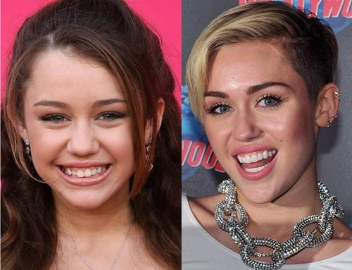 Nhan sắc người nổi tiếng trước và sau khi sửa răng