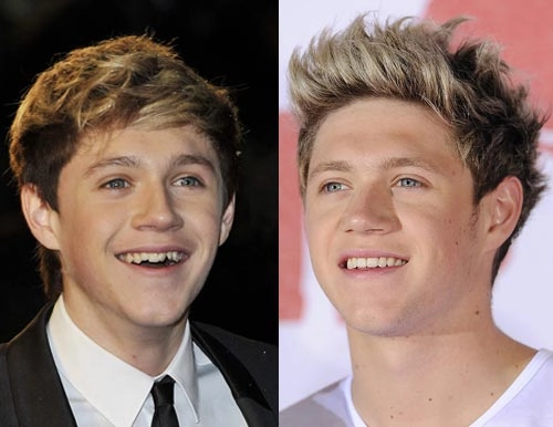 Nhan sắc người nổi tiếng trước và sau khi sửa răng