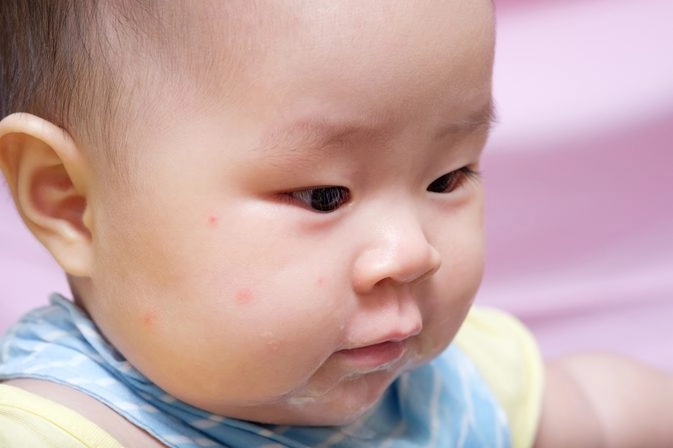 Trẻ sơ sinh bị nổi mẩn đỏ nên điều trị như thế nào