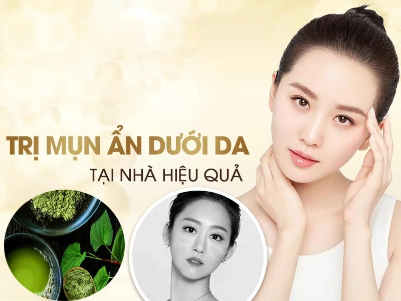 10 cách trị mụn ẩn dưới da tại nhà an toàn hiệu quả nhanh nhất