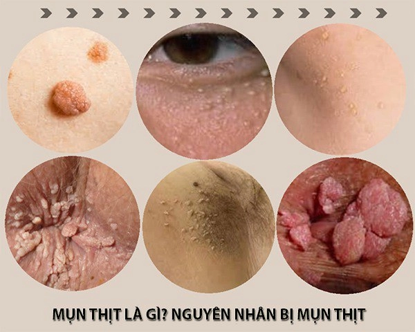 15 cách trị mụn thịt tận gốc tại nhà hiệu quả nhất hiện nay