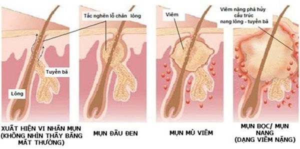 7 cách trị mụn bọc ở mũi từ nguyên liệu thiên nhiên tại nhà