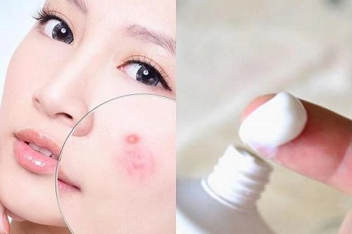 Bất ngờ trước cách trị mụn bọc chẳng tốn bao nhiêu tiền với kem đánh răng