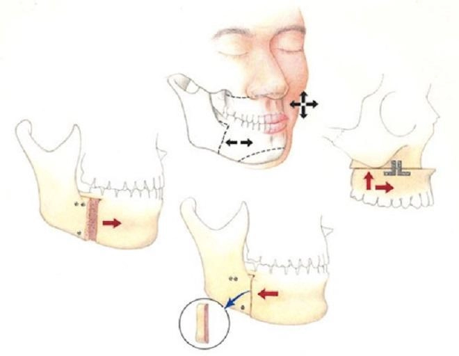 Bỏ gần 70 triệu cho một ca gọt cằm chị em nhận được gì