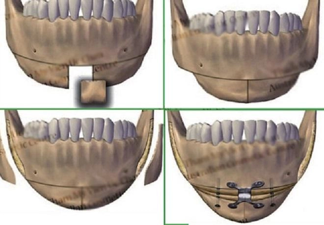 Bỏ gần 70 triệu cho một ca gọt cằm chị em nhận được gì