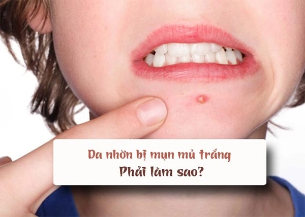 Cách trị mụn bọc sưng đỏ mủ ở mũi cằm tại nhà an toàn hiệu quả