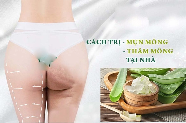 Cách trị mụn mông và thâm mông hiệu quả an toàn tại nhà