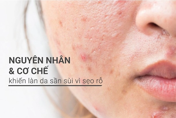 Cách trị sẹo rỗ trên mặt lâu năm tại nhà hiệu quả nhanh nhất