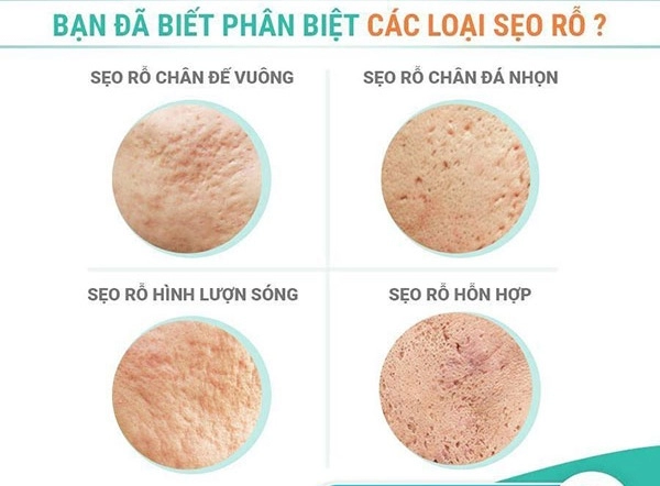 Cách trị sẹo rỗ trên mặt lâu năm tại nhà hiệu quả nhanh nhất