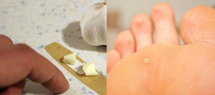 Đắp 3 thần dược này mỗi ngày bạn sẽ không bao giờ biết đến mụn cóc ở chân là gì