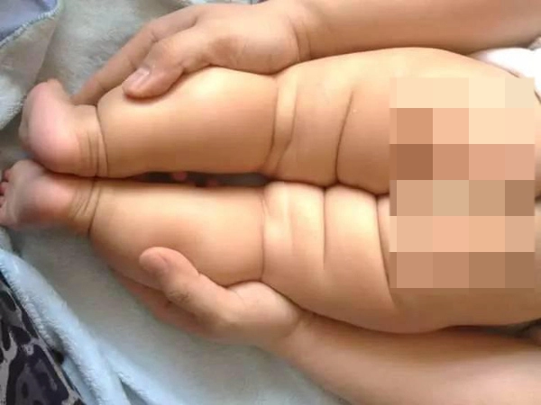 Đặt bé nằm sấp khép hai chân và tìm dấu hiệu dị tật trật khớp háng nguy hiểm
