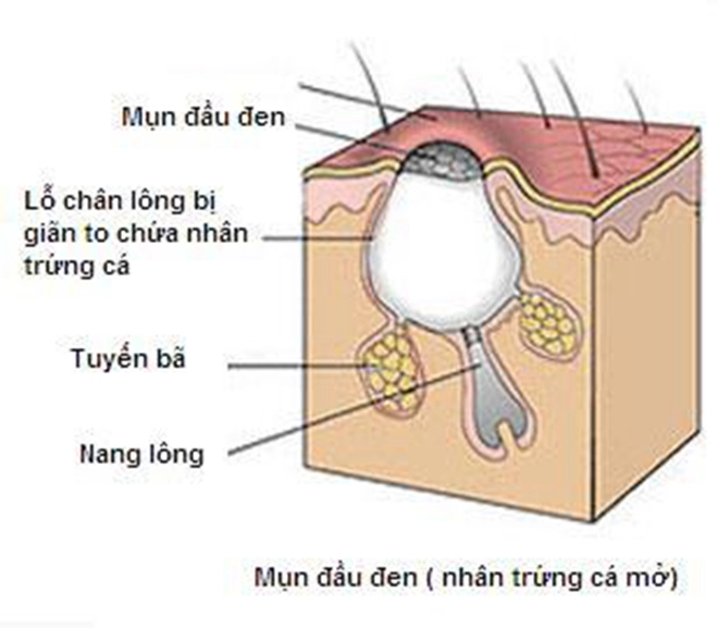 Đi tìm phương pháp trị mụn đầu đen hiệu quả nhất mà không làm tổn hại làn da