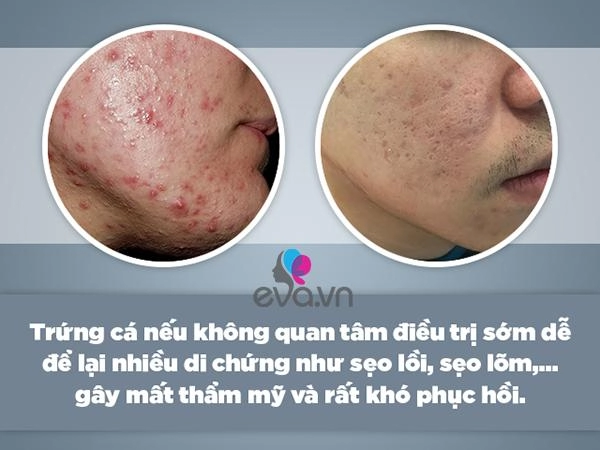 Giải tán vội nỗi ám ảnh mụn trứng cá đây chính xác là phương pháp thẩm mỹ bạn cần biết