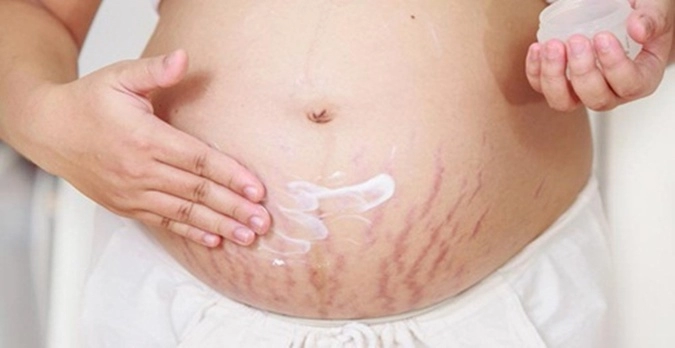Những cách phổ biến để chữa rạn chùng da bụng sau sinh mà chị em cần lưu ý