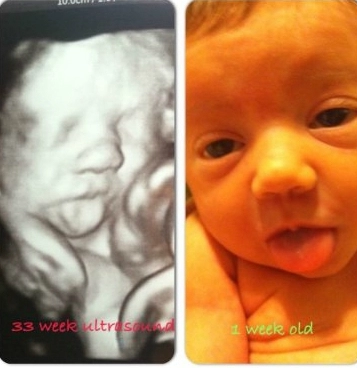 So sánh các bé khi siêu âm và lúc chào đời