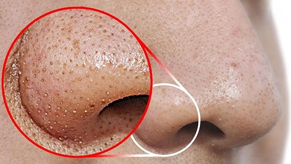 Các cách an toàn hiệu quả để loại bỏ mụn đầu đen vùng mũi