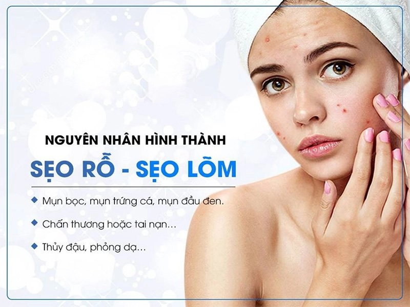 Cách trị sẹo rỗ lâu năm an toàn hiệu quả nhất từ nguyên liệu dễ kiếm