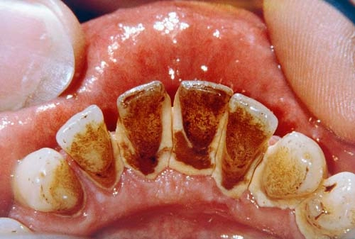 2 cách làm trắng răng đơn giản tại nhà không cần đi nha sĩ