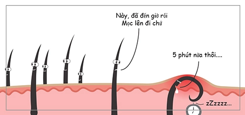 Dừng ngay việc nhổ lông nách bằng nhíp nếu không muốn rước họa vào thân