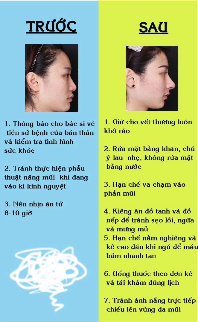 Nâng mũi bằng phương pháp dao kéo truyền thống bạn cần lưu ý những gì