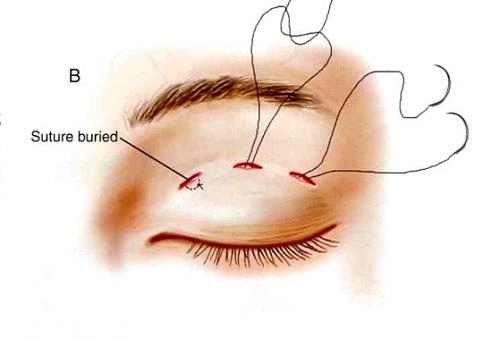 Muôn hình vạn trạng của cắt mí mắt mà chị em nào cũng nên nằm lòng thật kỹ