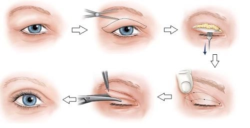 Muôn hình vạn trạng của cắt mí mắt mà chị em nào cũng nên nằm lòng thật kỹ