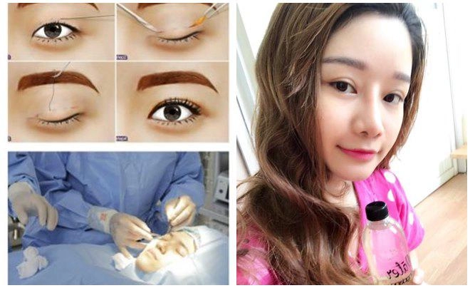 Nhật kí cắt mí mắt của cô nàng 9x từng lo sợ mắt sẽ bị trợn sau phẫu thuật