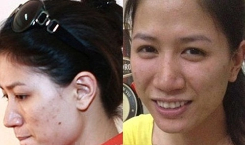 4 căn bệnh đau đớn hành hạ người mẫu