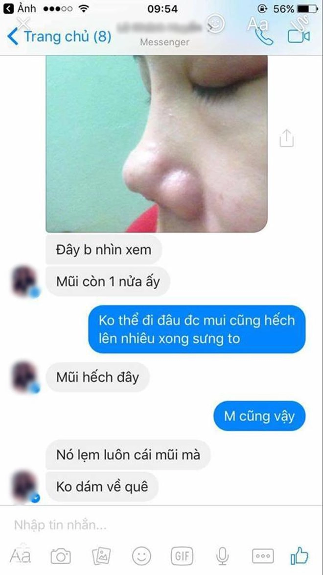 Bỏ 25 triệu làm mũi và bị hỏng cô gái phải chịu 9 lần khâu lại không thuốc tê